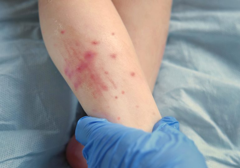 Why Measles Cases Are Rising Right Now