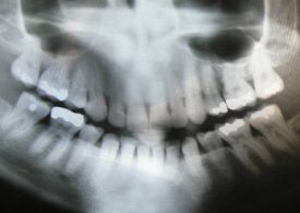 You May Not Need a Lead Apron for a Dental X-ray, a New Recommendation Says