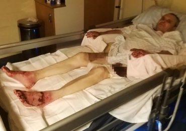 Ukrainian with half his skin burned off is dubbed ‘world’s hardest dad’ after ditching rehab to join sons back on front