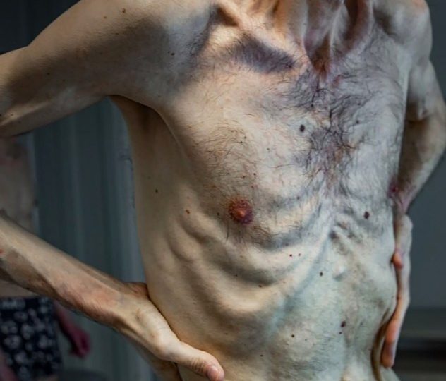 Horror pics show Ukrainian PoW looking like emaciated concentration camp victim after 2yrs being held by Putin’s forces