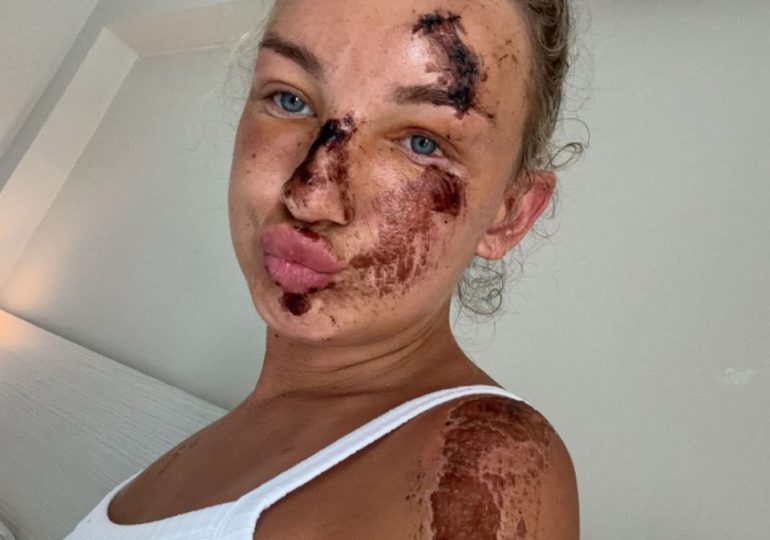 Holiday warning as Brit tourist, 21, shows off horror injuries after bloody quad bike crash on Greek holiday island