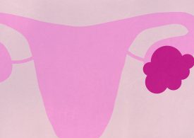 What to Do If You Get Diagnosed with an Ovarian Cyst