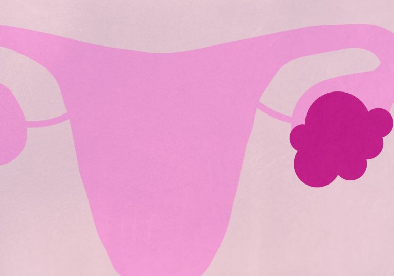 What to Do If You Get Diagnosed with an Ovarian Cyst