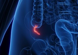 Appendix Cancer Has Quadrupled in Millennials