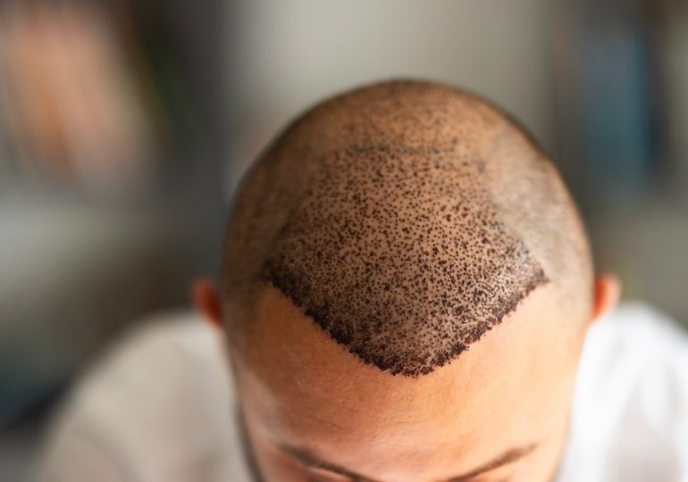 Brit tourist, 38, dies after Turkey hair transplant goes wrong with probe launched into clinic