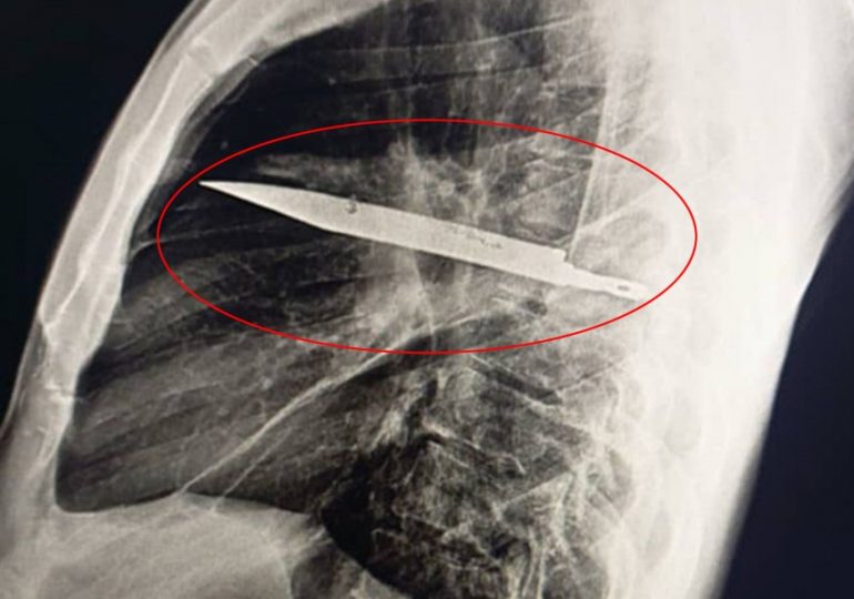 Man complains of sore nipple only for docs to find giant KNIFE had been lodged in his chest for eight years
