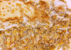 Why Syphilis Cases in Newborns Are Rising Even as STIs Decline