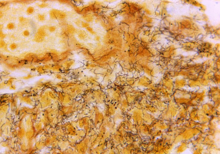 Why Syphilis Cases in Newborns Are Rising Even as STIs Decline