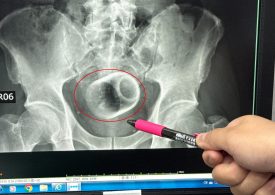 Teacup found in man’s bottom after he went to hospital complaining of constipation