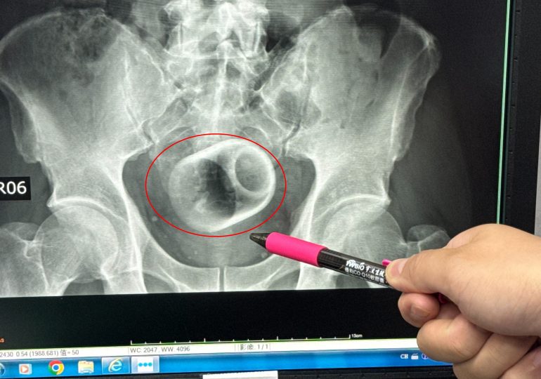 Teacup found in man’s bottom after he went to hospital complaining of constipation