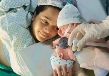 Conjoined twin dies after emergency operation to separate him from his lifeless brother days after high-risk delivery