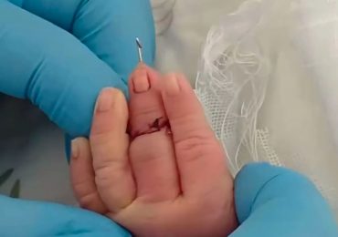 Midwife suspended after nearly cutting baby’s finger off when she was severing his umbilical cord moments after birth