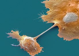 Two New Drugs Offer Hope for Pancreatic Cancer